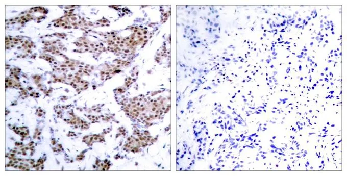 IHC-P analysis of human breast carcinoma tissue using GTX50114 MEF2A (phospho Thr312) antibody. Left : Primary antibody Right : Primary antibody pre-incubated with the antigen specific peptide