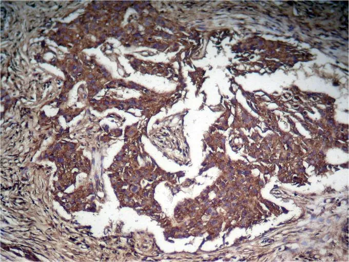 IHC-P analysis of human lung carcinoma tissue using GTX50119 STAT3 (phospho Tyr705) antibody.