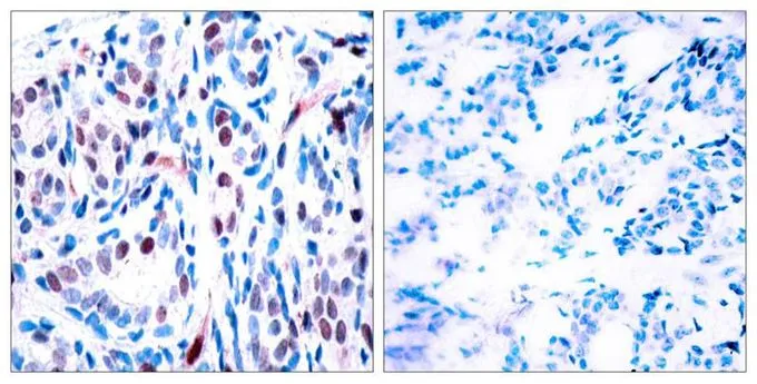 IHC-P analysis of human breast carcinoma tissue using GTX50119 STAT3 (phospho Tyr705) antibody. Left : Primary antibody Right : Primary antibody pre-incubated with the antigen specific peptide