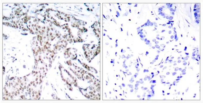 IHC-P analysis of human breast carcinoma tissue using GTX50120 STAT3 (phospho Ser727) antibody. Left : Primary antibody Right : Primary antibody pre-incubated with the antigen specific peptide