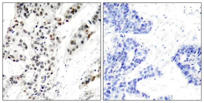 IHC-P analysis of human breast carcinoma tissue using GTX50138 Estrogen Receptor alpha (phospho Ser106) antibody. Left : Primary antibody Right : Primary antibody pre-incubated with the antigen specific peptide