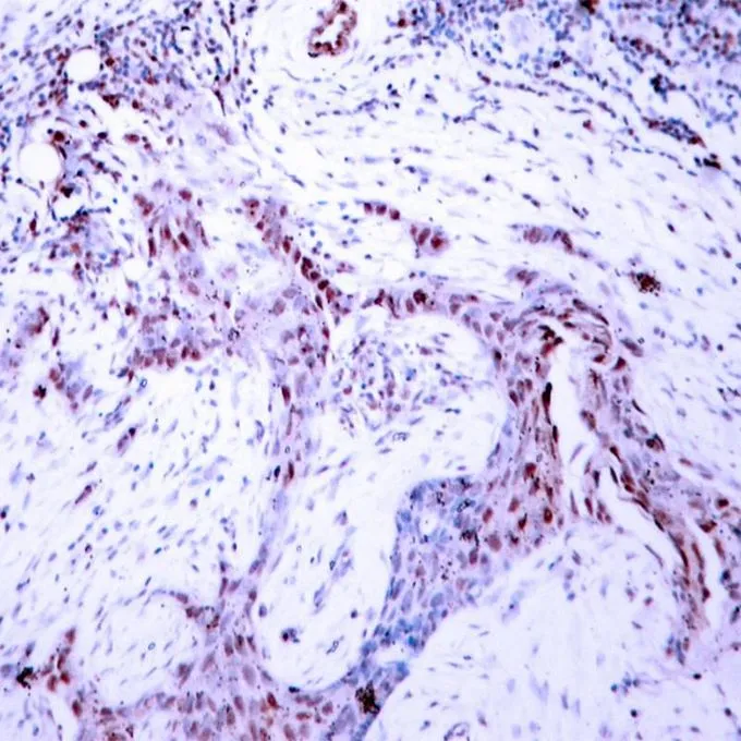 IHC-P analysis of human breast carcinoma tissue using GTX50141 Progesterone Receptor (phospho Ser190) antibody.