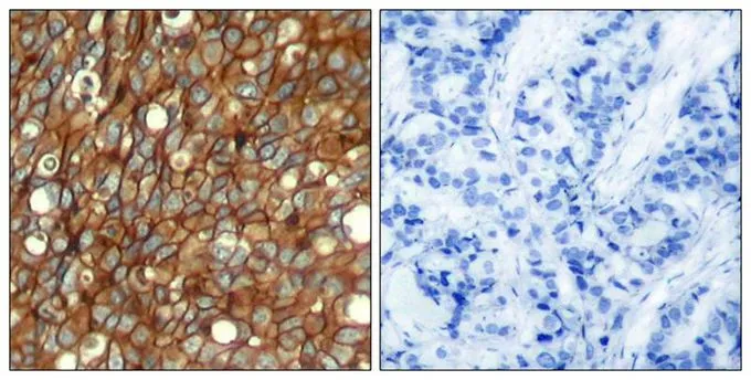 IHC-P analysis of human breast carcinoma tissue using GTX50146 Her2 / ErbB2 (phospho Tyr1248) antibody. Left : Primary antibody Right : Primary antibody pre-incubated with the antigen specific peptide