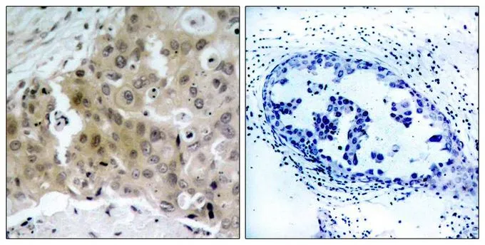 IHC-P analysis of human breast carcinoma tissue using GTX50151 VEGF Receptor 2 (phospho Tyr1175) antibody. Left : Primary antibody Right : Primary antibody pre-incubated with the antigen specific peptide