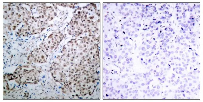 IHC-P analysis of human breast carcinoma tissue using GTX50164 p53 (phospho Ser315) antibody. Left : Primary antibody Right : Primary antibody pre-incubated with the antigen specific peptide