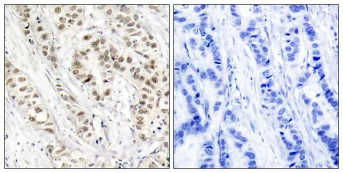 IHC-P analysis of human breast carcinoma tissue using GTX50181 BRCA1 (phospho Ser1524) antibody. Left : Primary antibody Right : Primary antibody pre-incubated with the antigen specific peptide