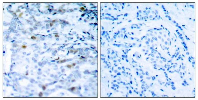 IHC-P analysis of human breast carcinoma tissue using GTX50195 CDC2 (phospho Thr161) antibody. Left : Primary antibody Right : Primary antibody pre-incubated with the antigen specific peptide