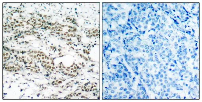 IHC-P analysis of human breast carcinoma tissue using GTX50197 FOXO4 (phospho Ser197) antibody. Left : Primary antibody Right : Primary antibody pre-incubated with the antigen specific peptide