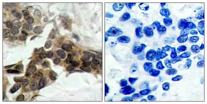 IHC-P analysis of human breast carcinoma tissue using GTX50209 IKB alpha (phospho Ser32/Ser36) antibody. Left : Primary antibody Right : Primary antibody pre-incubated with the antigen specific peptide