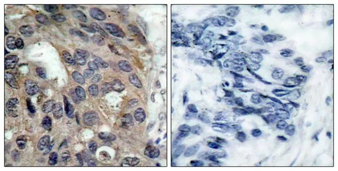 IHC-P analysis of human breast carcinoma tissue using GTX50210 Src (phospho Tyr527) antibody. Left : Primary antibody Right : Primary antibody pre-incubated with the antigen specific peptide