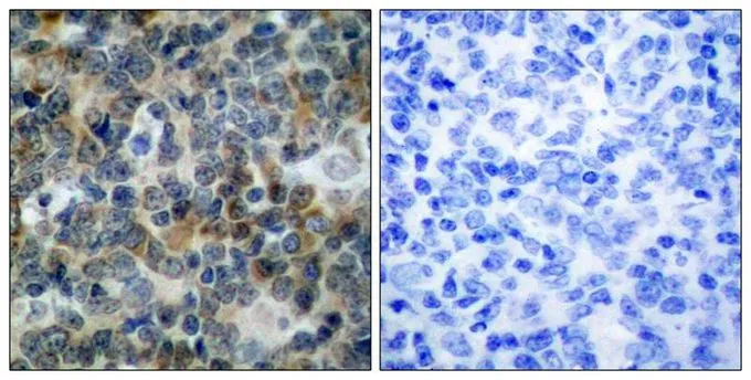 IHC-P analysis of human tonsil carcinoma tissue using GTX50213 VASP (phospho Ser239) antibody. Left : Primary antibody Right : Primary antibody pre-incubated with the antigen specific peptide IHC-P analysis of human tonsil carcinoma tissue using GTX50213 VASP (phospho Ser239) antibody. Left : Primary antibody Right : Primary antibody pre-incubated with the antigen specific peptide