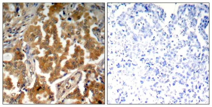 IHC-P analysis of human lung carcinoma tissue using GTX50230 alpha Adducin (phospho Ser726) antibody. Left : Primary antibody Right : Primary antibody pre-incubated with the antigen specific peptide