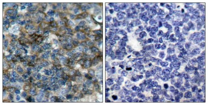 IHC-P analysis of human tonsil carcinoma tissue using GTX50253 VASP (phospho Ser157) antibody. Left : Primary antibody Right : Primary antibody pre-incubated with the antigen specific peptide