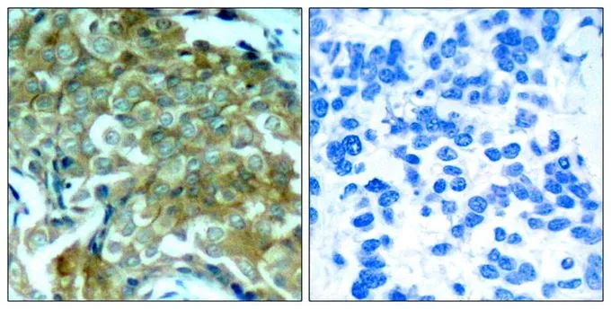 IHC-P analysis of human breast carcinoma tissue using GTX50257 EGFR (phospho Tyr1148) antibody. Left : Primary antibody Right : Primary antibody pre-incubated with the antigen specific peptide IHC-P analysis of human breast carcinoma tissue using GTX50257 EGFR (phospho Tyr1148) antibody. Left : Primary antibody Right : Primary antibody pre-incubated with the antigen specific peptide
