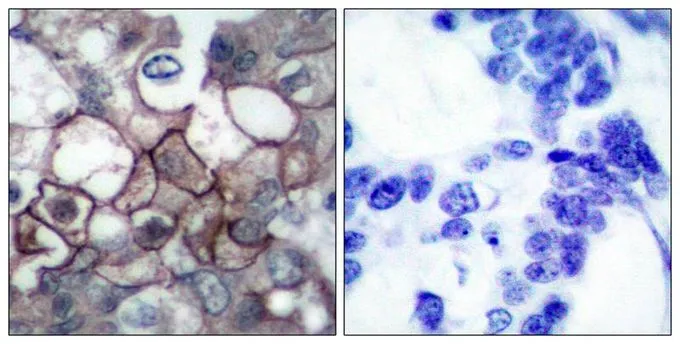 IHC-P analysis of human breast carcinoma tissue using GTX50263 EGFR (phospho Tyr1173) antibody. Left : Primary antibody Right : Primary antibody pre-incubated with the antigen specific peptide IHC-P analysis of human breast carcinoma tissue using GTX50263 EGFR (phospho Tyr1173) antibody. Left : Primary antibody Right : Primary antibody pre-incubated with the antigen specific peptide