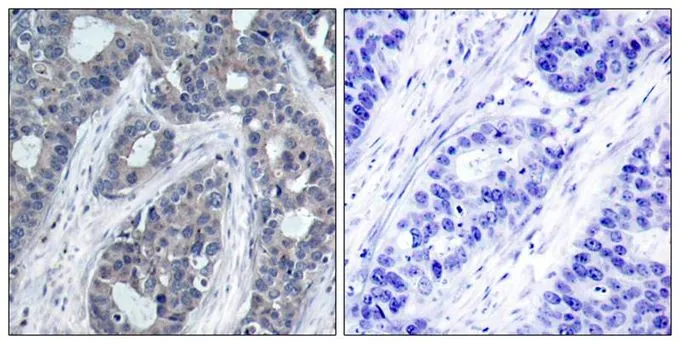 IHC-P analysis of human breast carcinoma tissue using GTX50265 IRS1 (phospho Ser636) antibody. Left : Primary antibody Right : Primary antibody pre-incubated with the antigen specific peptide IHC-P analysis of human breast carcinoma tissue using GTX50265 IRS1 (phospho Ser636) antibody. Left : Primary antibody Right : Primary antibody pre-incubated with the antigen specific peptide