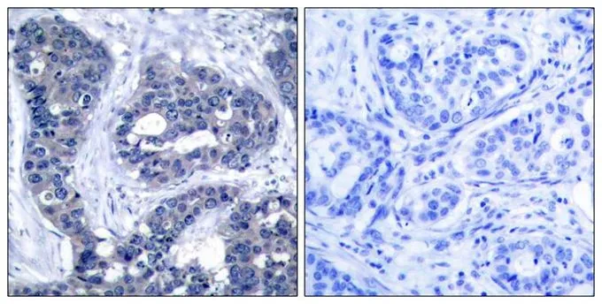 IHC-P analysis of human breast carcinoma tissue using GTX50266 IRS1 (phospho Ser639) antibody. Left : Primary antibody Right : Primary antibody pre-incubated with the antigen specific peptide