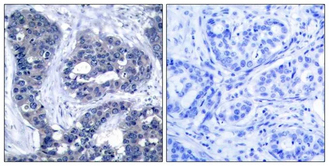 IHC-P analysis of human breast carcinoma tissue using GTX50266 IRS1 (phospho Ser639) antibody. Left : Primary antibody Right : Primary antibody pre-incubated with the antigen specific peptide IHC-P analysis of human breast carcinoma tissue using GTX50266 IRS1 (phospho Ser639) antibody. Left : Primary antibody Right : Primary antibody pre-incubated with the antigen specific peptide