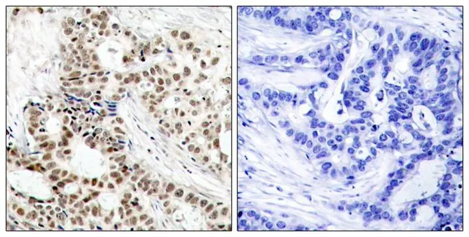 IHC-P analysis of human breast carcinoma tissue using GTX50272 BRCA1 (phospho Ser1423) antibody. Left : Primary antibody Right : Primary antibody pre-incubated with the antigen specific peptide