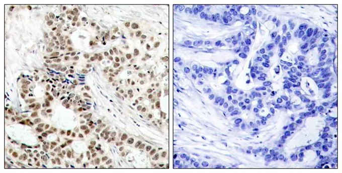 IHC-P analysis of human breast carcinoma tissue using GTX50272 BRCA1 (phospho Ser1423) antibody. Left : Primary antibody Right : Primary antibody pre-incubated with the antigen specific peptide IHC-P analysis of human breast carcinoma tissue using GTX50272 BRCA1 (phospho Ser1423) antibody. Left : Primary antibody Right : Primary antibody pre-incubated with the antigen specific peptide