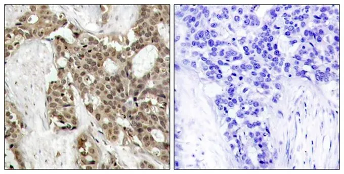IHC-P analysis of human breast carcinoma tissue using GTX50275 ERK1 (phospho Tyr204) + ERK2 (phospho Tyr187) antibody. Left : Primary antibody Right : Primary antibody pre-incubated with the antigen specific peptide