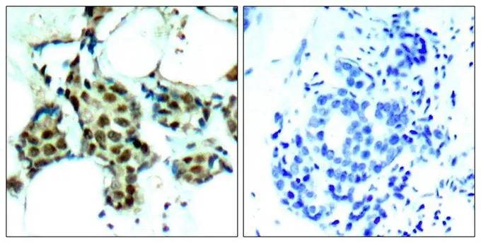 IHC-P analysis of human breast carcinoma tissue using GTX50281 p38 MAPK (phospho Tyr182) antibody. Left : Primary antibody Right : Primary antibody pre-incubated with the antigen specific peptide IHC-P analysis of human breast carcinoma tissue using GTX50281 p38 MAPK (phospho Tyr182) antibody. Left : Primary antibody Right : Primary antibody pre-incubated with the antigen specific peptide