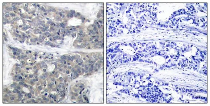 IHC-P analysis of human breast carcinoma tissue using GTX50282 p70 S6K (phospho Thr421) antibody. Left : Primary antibody Right : Primary antibody pre-incubated with the antigen specific peptide