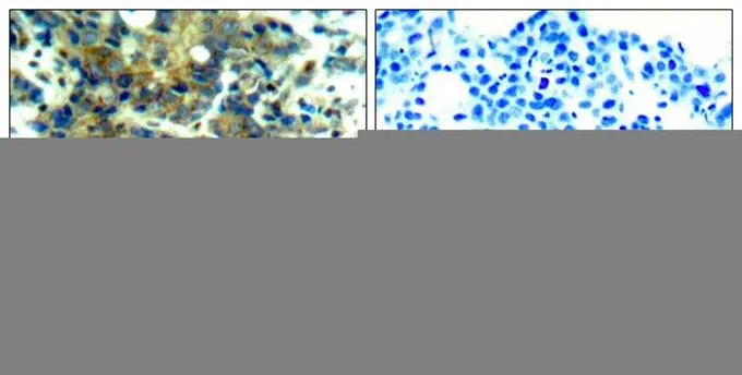 IHC-P analysis of human breast carcinoma tissue using GTX50294 p70 S6K (phospho Ser411) antibody. Left : Primary antibody Right : Primary antibody pre-incubated with the antigen specific peptide