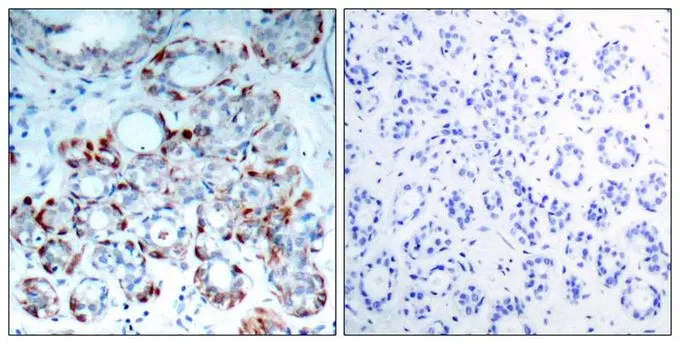 IHC-P analysis of human breast carcinoma tissue using GTX50308 Bim (phospho Ser69) antibody. Left : Primary antibody Right : Primary antibody pre-incubated with the antigen specific peptide