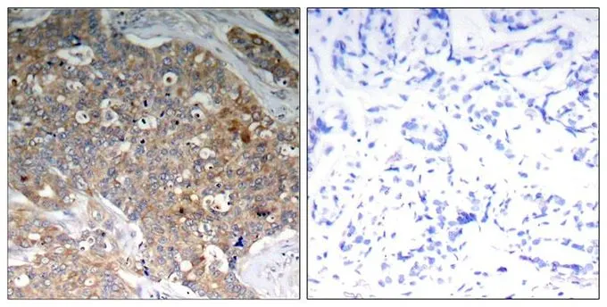 IHC-P analysis of human breast carcinoma tissue using GTX50316 GSK3 alpha (phospho Tyr279) + GSK3 beta (phospho Tyr216) antibody. Left : Primary antibody Right : Primary antibody pre-incubated with the antigen specific peptide