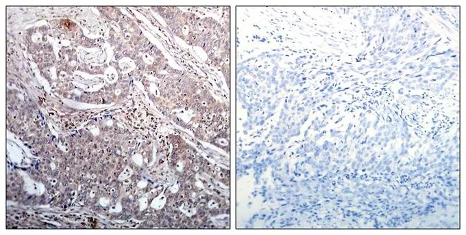 IHC-P analysis of human breast carcinoma tissue using GTX50317 IKB beta (phospho Ser23) antibody. Left : Primary antibody Right : Primary antibody pre-incubated with the antigen specific peptide IHC-P analysis of human breast carcinoma tissue using GTX50317 IKB beta (phospho Ser23) antibody. Left : Primary antibody Right : Primary antibody pre-incubated with the antigen specific peptide