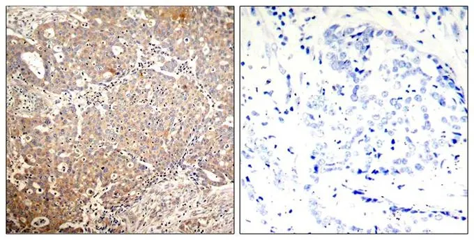 IHC-P analysis of human breast carcinoma tissue using GTX50318 Cytokeratin 18 (phospho Ser33) antibody. Left : Primary antibody Right : Primary antibody pre-incubated with the antigen specific peptide IHC-P analysis of human breast carcinoma tissue using GTX50318 Cytokeratin 18 (phospho Ser33) antibody. Left : Primary antibody Right : Primary antibody pre-incubated with the antigen specific peptide