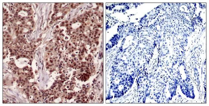 IHC-P analysis of human breast carcinoma tissue using GTX50324 NFkB p105 (phospho Ser927) antibody. Left : Primary antibody Right : Primary antibody pre-incubated with the antigen specific peptide