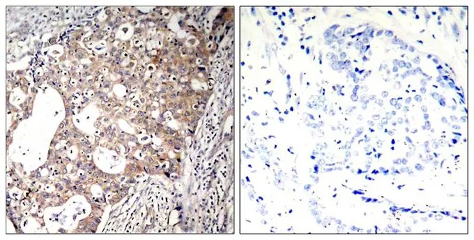 IHC-P analysis of human breast carcinoma tissue using GTX50326 SHC1 (phospho Tyr317) antibody. Left : Primary antibody Right : Primary antibody pre-incubated with the antigen specific peptide