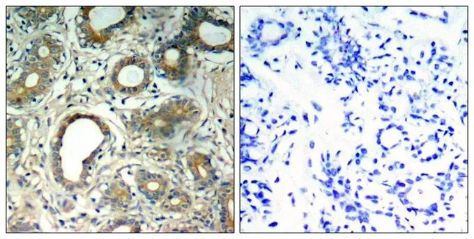 IHC-P analysis of human breast carcinoma tissue using GTX50329 SHP2 (phospho Tyr580) antibody. Left : Primary antibody Right : Primary antibody pre-incubated with the antigen specific peptide IHC-P analysis of human breast carcinoma tissue using GTX50329 SHP2 (phospho Tyr580) antibody. Left : Primary antibody Right : Primary antibody pre-incubated with the antigen specific peptide