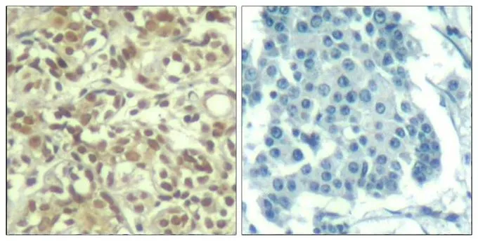 IHC-P analysis of human breast carcinoma tissue using GTX50339 AKT (phospho Thr450) antibody. Left : Primary antibody Right : Primary antibody pre-incubated with the antigen specific peptide