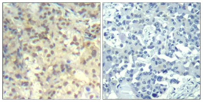 IHC-P analysis of human lung carcinoma tissue using GTX50340 Cofilin 1 (phospho Tyr139) antibody. Left : Primary antibody Right : Primary antibody pre-incubated with the antigen specific peptide