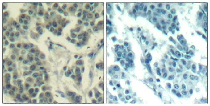 IHC-P analysis of human breast carcinoma tissue using GTX50341 Her3 / ErbB3 (phospho Tyr1328) antibody. Left : Primary antibody Right : Primary antibody pre-incubated with the antigen specific peptide