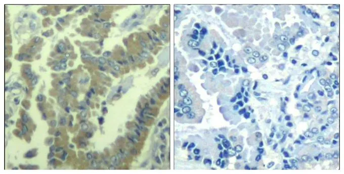 IHC-P analysis of human lung carcinoma tissue using GTX50348 MARCKS (phospho Ser170) antibody. Left : Primary antibody Right : Primary antibody pre-incubated with the antigen specific peptide IHC-P analysis of human lung carcinoma tissue using GTX50348 MARCKS (phospho Ser170) antibody. Left : Primary antibody Right : Primary antibody pre-incubated with the antigen specific peptide