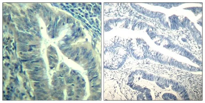 IHC-P analysis of human colon carcinoma tissue using GTX50353 CDK6 (Phospho Tyr24) antibody. Left : Primary antibody Right : Primary antibody pre-incubated with the antigen specific peptide