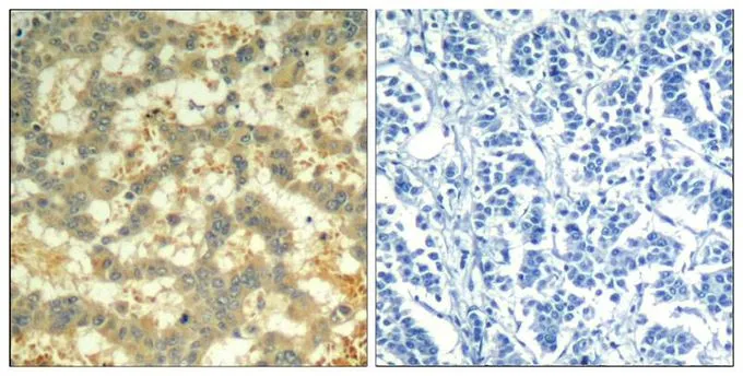 IHC-P analysis of human breast carcinoma tissue using GTX50355 Syk (phospho Tyr323) antibody. Left : Primary antibody Right : Primary antibody pre-incubated with the antigen specific peptide