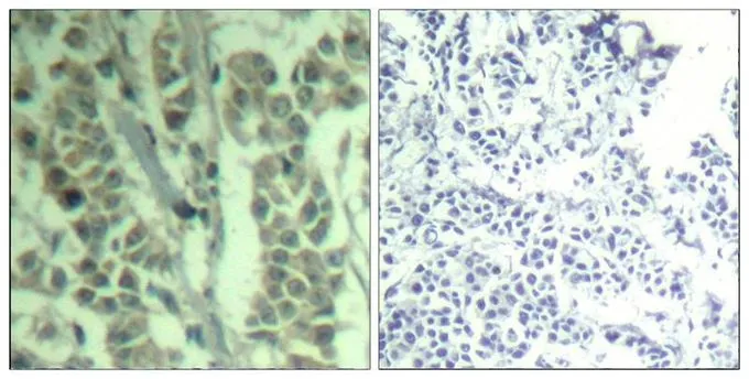 IHC-P analysis of human breast carcinoma tissue using GTX50356 CBL (phospho Tyr700) antibody. Left : Primary antibody Right : Primary antibody pre-incubated with the antigen specific peptide