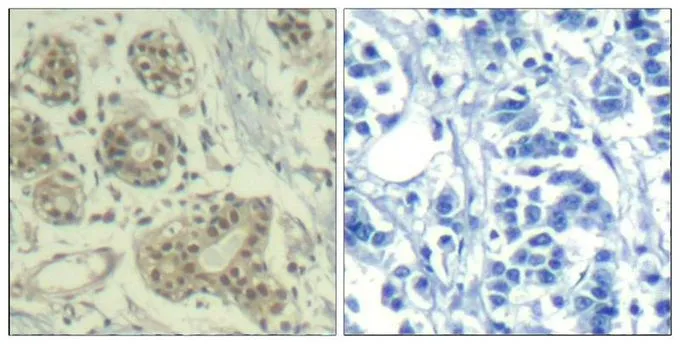 IHC-P analysis of human breast carcinoma tissue using GTX50357 MDM2 (phospho Ser166) antibody. Left : Primary antibody Right : Primary antibody pre-incubated with the antigen specific peptide