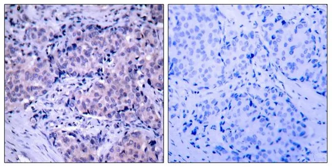 IHC-P analysis of human breast carcinoma tissue using GTX50366 PDPK1 / PDK1 antibody. Left : Primary antibody Right : Primary antibody pre-incubated with the antigen specific peptide