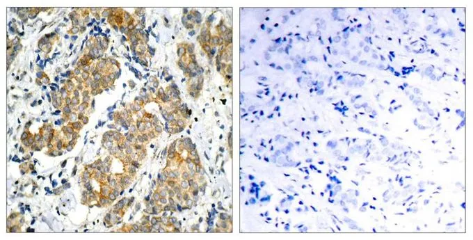 IHC-P analysis of human breast carcinoma tissue using GTX50368 GSK3 alpha antibody. Left : Primary antibody Right : Primary antibody pre-incubated with the antigen specific peptide