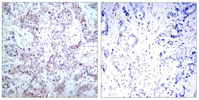 IHC-P analysis of human breast carcinoma tissue using GTX50374 NFkB p65 antibody. Left : Primary antibody Right : Primary antibody pre-incubated with the antigen specific peptide IHC-P analysis of human breast carcinoma tissue using GTX50374 NFkB p65 antibody. Left : Primary antibody Right : Primary antibody pre-incubated with the antigen specific peptide