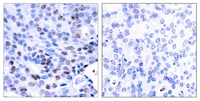 IHC-P analysis of human breast carcinoma tissue using GTX50377 NFkB p105/p50 antibody. Left : Primary antibody Right : Primary antibody pre-incubated with the antigen specific peptide IHC-P analysis of human breast carcinoma tissue using GTX50377 NFkB p105/p50 antibody. Left : Primary antibody Right : Primary antibody pre-incubated with the antigen specific peptide