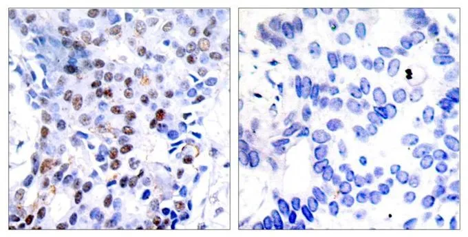 IHC-P analysis of human breast carcinoma tissue using GTX50381 c-Jun antibody. Left : Primary antibody Right : Primary antibody pre-incubated with the antigen specific peptide