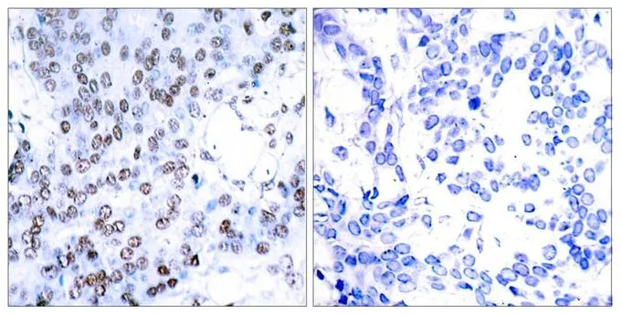 IHC-P analysis of human breast carcinoma tissue using GTX50386 JunB antibody. Left : Primary antibody Right : Primary antibody pre-incubated with the antigen specific peptide