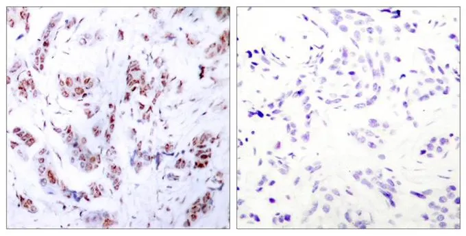 IHC-P analysis of human breast carcinoma tissue using GTX50397 MEF2A antibody. Left : Primary antibody Right : Primary antibody pre-incubated with the antigen specific peptide